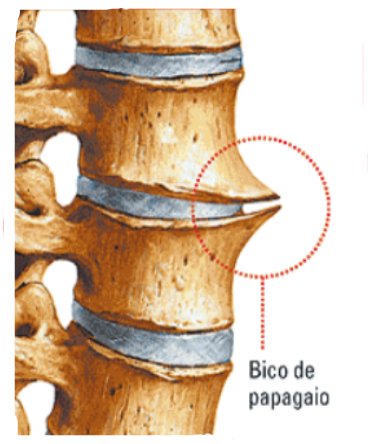 Dor Na Coluna Pode Ser Bico De Papagaio | Dor Na Coluna - O Que Fazer?